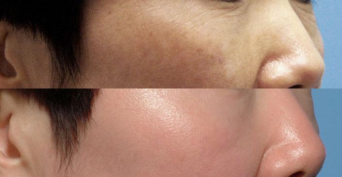 Middlesex County Hyperpigmentation